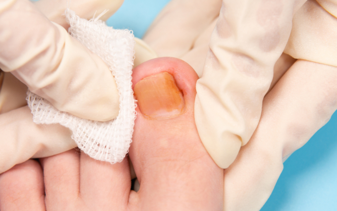ingrown-toenails-causes-risks-and-solutions